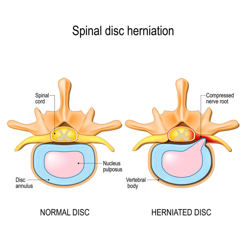 An illustration of a normal vs herniated disc